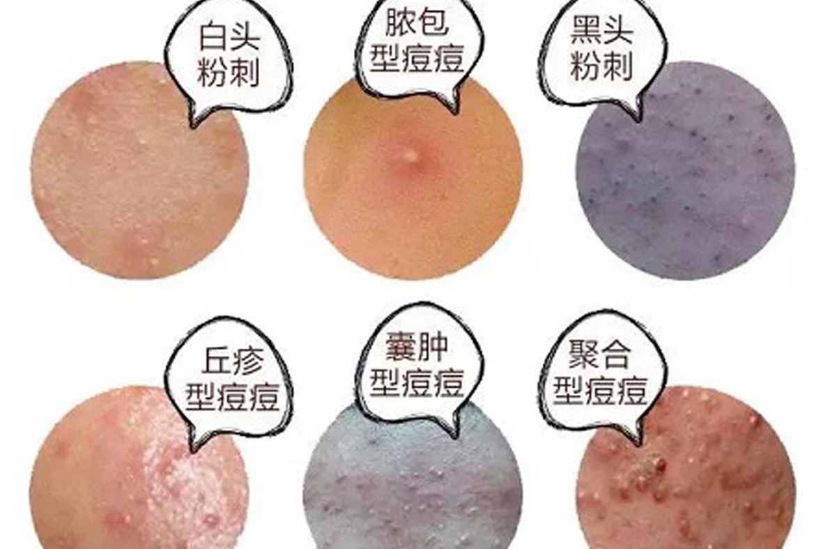 平痘復合劑0.jpg
